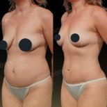 Resultados de abdominoplastia antes y después en Memorial Bahçelievler Hospital, abdomen definido