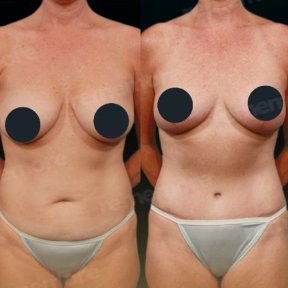 Resultados de abdominoplastia antes y después en Memorial Bahçelievler Hospital, abdomen mejorado