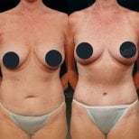 Resultados de abdominoplastia antes y después en Memorial Bahçelievler Hospital, abdomen mejorado