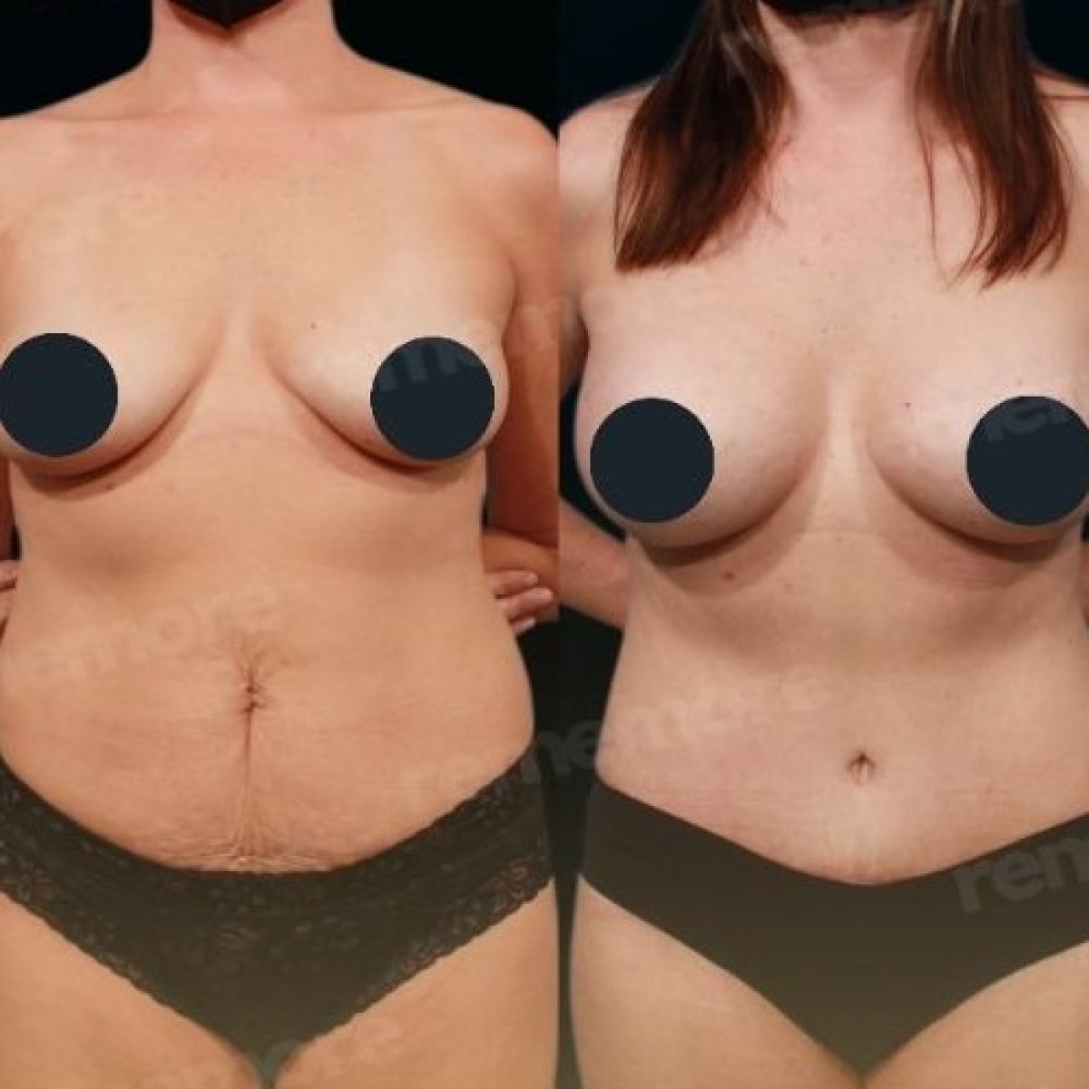 Resultados de abdominoplastia antes y después en Memorial Bahçelievler Hospital, abdomen mejorado