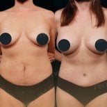 Resultados de abdominoplastia antes y después en Memorial Bahçelievler Hospital, abdomen mejorado