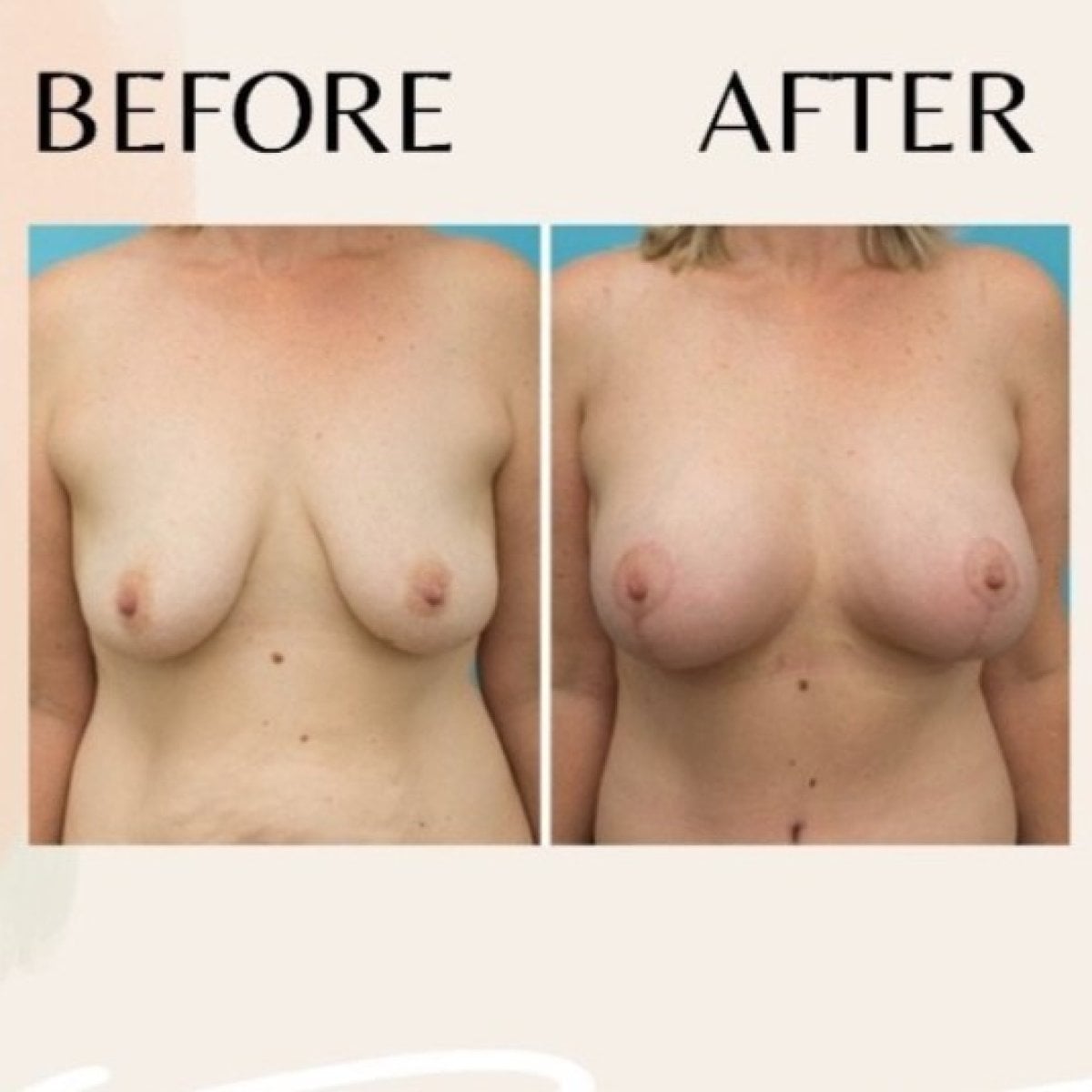 Resultados antes y después de implantes y lifting de senos en ID Clinic Bangkok, forma mejorada