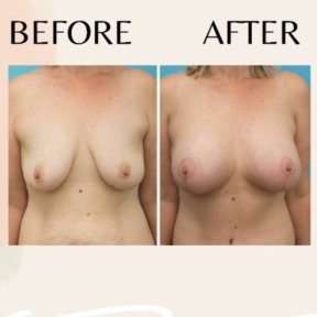 Before and after breast implants with lift results at ID Clinic Bangkok, enhanced breast shape