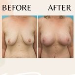 Before and after breast implants with lift results at ID Clinic Bangkok, enhanced breast shape
