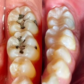 Результаты до и после эстетической композитной пломбы в Teethsavers Dental Clinic