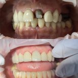 Vorher-nachher-Ergebnis Kroneninstallation bei Teethsavers Dental Clinic, verbesserte Zähne