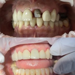Vorher-nachher-Ergebnis Porzellankronen bei Teethsavers Dental Clinic, verbesserte Zahnästhetik