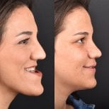 Wyniki przed i po chirurgii ortognatycznej w Dentavie Istanbul Dental Clinic, korekta szczęki