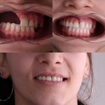 Before and after jaw implant results at Dentavie Istanbul Dental Clinic, improved smile alignment