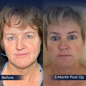 Vorher-nachher-Ergebnis Brauenlifting bei Dr. Safa Manav Clinic, 5 Monate postoperativ