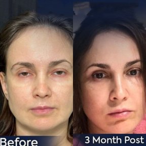 Augenbrauenlifting Vorher-Nachher-Ergebnis bei Dr. Safa Manav Clinic, sichtbare Verbesserung