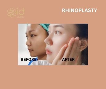 Before and after rhinoplasty results at ID Clinic Bangkok, nose reshaping with natural look