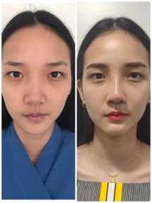 Before and after rhinoplasty result at ID Clinic Bangkok, nose reshaping with natural look
