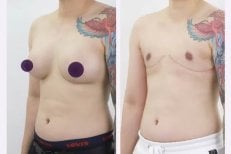Before and after top surgery results at ID Clinic Bangkok – chest masculinization transformation