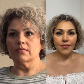 Before and after deep plane facelift results at Marroquín & Sandoval Plastic Surgery Clinic