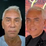 Deep plane facelift before and after results at Marroquín & Sandoval Plastic Surgery Clinic