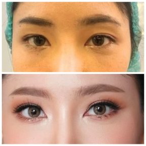 Before and after blepharoplasty results at ID Clinic Bangkok, eyelid correction for brighter eyes