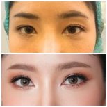 Before and after blepharoplasty results at ID Clinic Bangkok, eyelid correction for brighter eyes