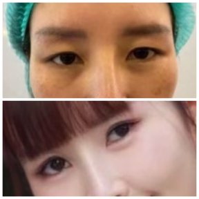 Before and after blepharoplasty results at ID Clinic Bangkok, eyelid correction for brighter eyes