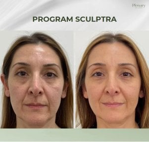 Efekty odmładzania twarzy Sculptra przed i po w Plenary Wellness, poprawa skóry