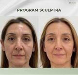 Efekty odmładzania twarzy Sculptra przed i po w Plenary Wellness, poprawa skóry