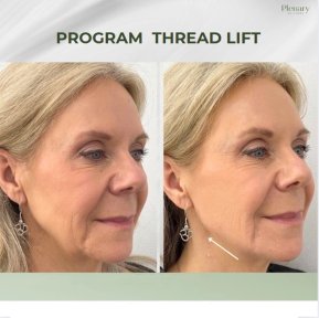 Resultados antes y después de lifting con hilos en Plenary Wellness, piel facial más firme