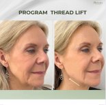 Resultados antes y después de lifting con hilos en Plenary Wellness, piel facial más firme