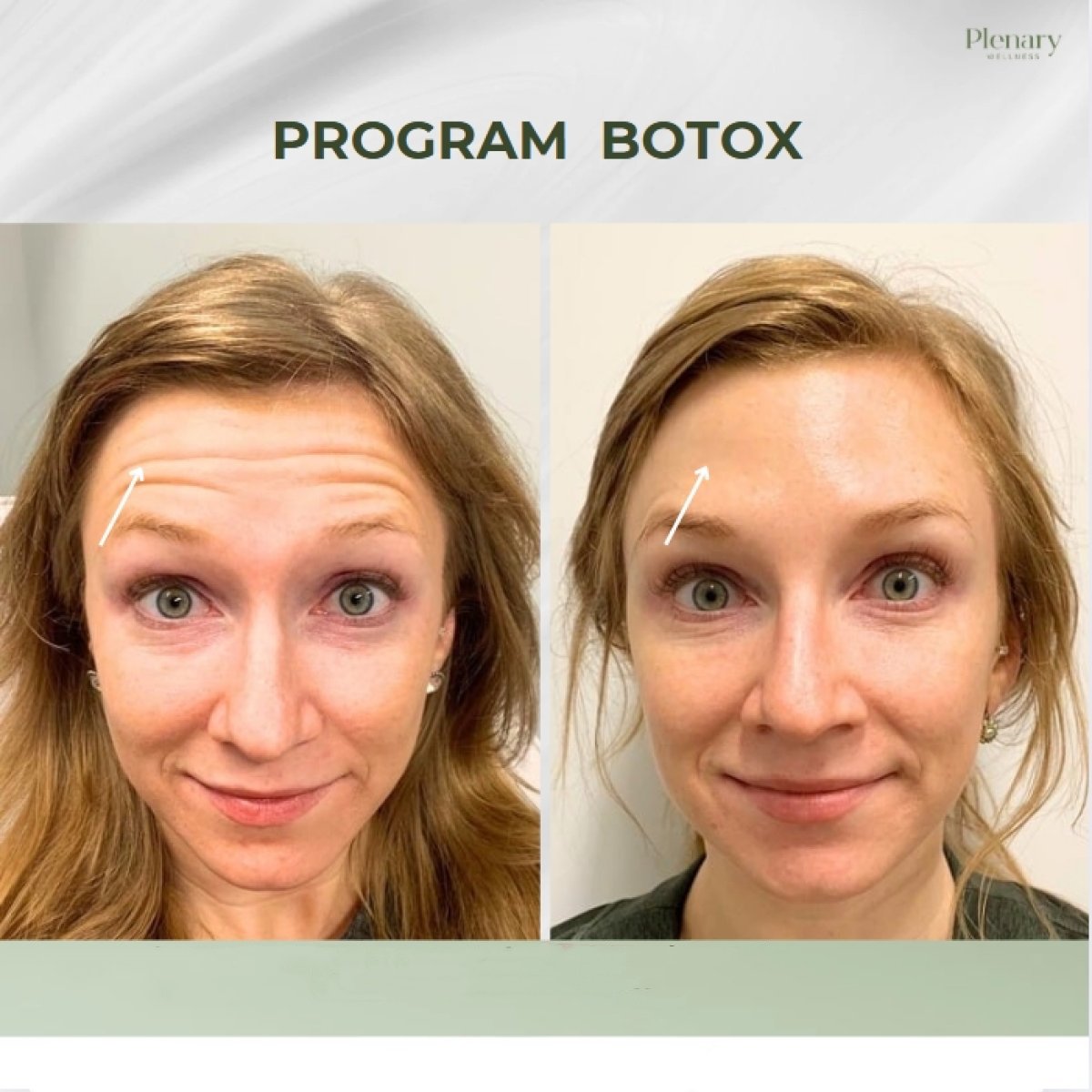 Avant et après injections de Botox chez Plenary Wellness, réduction des rides du front