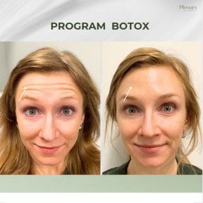 До і після ін'єкцій ботоксу в Plenary Wellness, результат зменшення зморшок на лобі