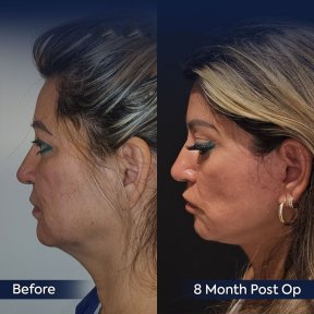 Before and after brow lift results at Dr. Safa Manav Clinic, 8 months post-op facial rejuvenation