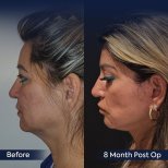 Before and after brow lift results at Dr. Safa Manav Clinic, 8 months post-op facial rejuvenation