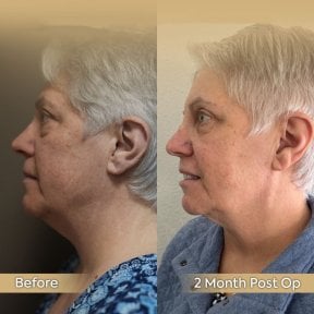 Blepharoplastik Vorher-Nachher-Ergebnis bei Dr. Safa Manav Clinic, verbesserte Augenlider