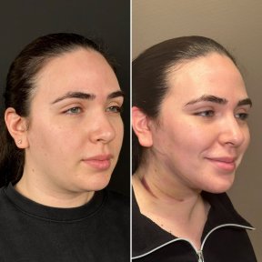 Before and after facial feminization surgery results at Dr. Safa Manav Clinic, refined features