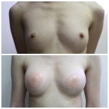 Before and after breast augmentation with fat transfer results at Wansiri Hospital