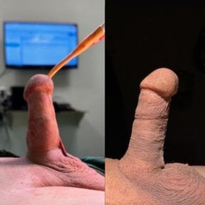 Vorher-nachher-Ergebnis Penisimplantat-OP bei Uroaesthetic, verbesserte Form und Funktion