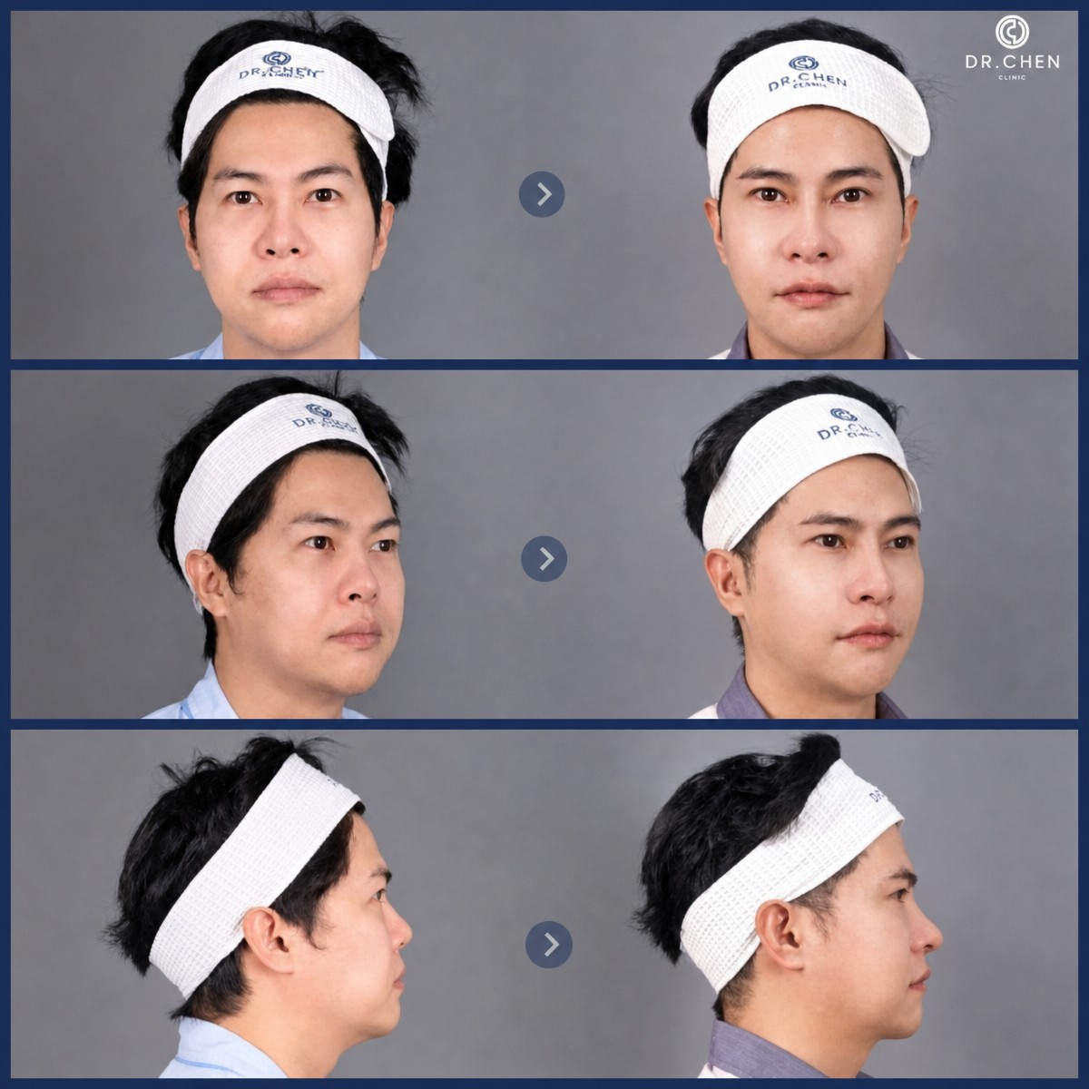Resultados antes y después de extracción de grasa bucal en Dr. Chen Surgery Hospital International Center