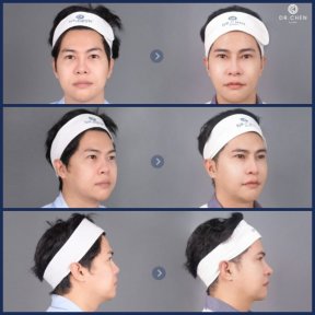 Before and after buccal fat extraction results at Dr. Chen Surgery Hospital International Center