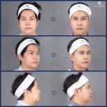 Before and after buccal fat extraction results at Dr. Chen Surgery Hospital International Center