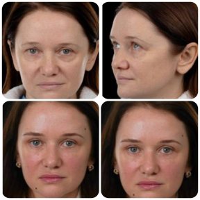 Before and after deep plane facelift results at Yurchenko Plastic Surgery Team Kyiv, facial rejuvenation