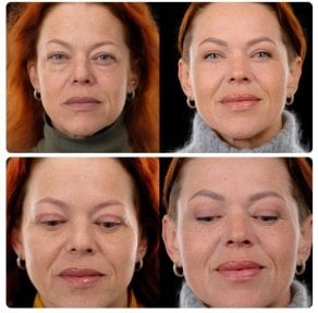 Результаты до и после deep plane SMAS-лифтинга в Yurchenko Plastic Surgery Team Kyiv, омоложение лица