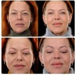 Результаты до и после deep plane SMAS-лифтинга в Yurchenko Plastic Surgery Team Kyiv, омоложение лица