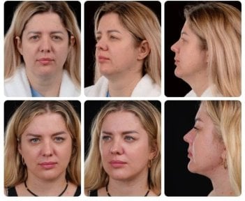 نتائج شد الوجه العميق قبل وبعد في Yurchenko Plastic Surgery Team Kyiv، تجديد شباب الوجه