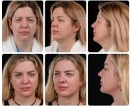 نتائج شد الوجه العميق قبل وبعد في Yurchenko Plastic Surgery Team Kyiv، تجديد شباب الوجه