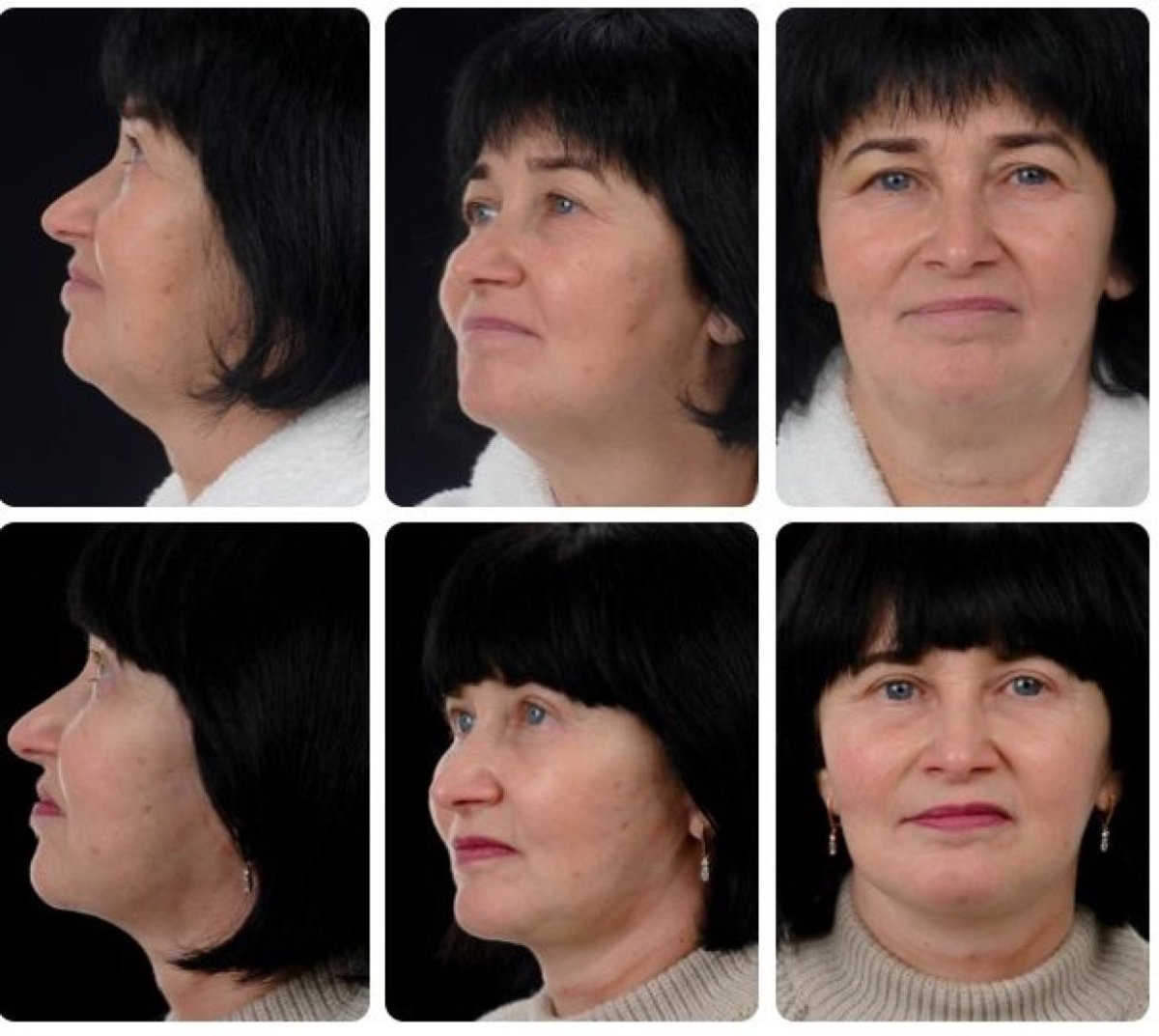 Vorher-nachher-Ergebnisse Deep Plane Facelift bei Yurchenko Plastic Surgery Team Kyiv, Gesichtsverjüngung