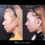 Vorher-nachher-Ergebnis Deep Plane Facelift bei VG Plastic Surgery, sichtbare Verjüngung