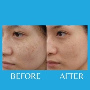 Before and after laser scar removal at ID Clinic Bangkok, improved facial skin texture result