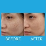 Before and after laser scar removal at ID Clinic Bangkok, improved facial skin texture result