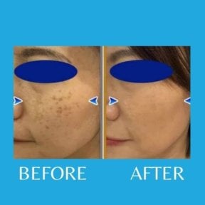 Before and after laser scar removal results at ID Clinic Bangkok, improved facial skin clarity