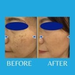Before and after laser scar removal results at ID Clinic Bangkok, improved facial skin clarity