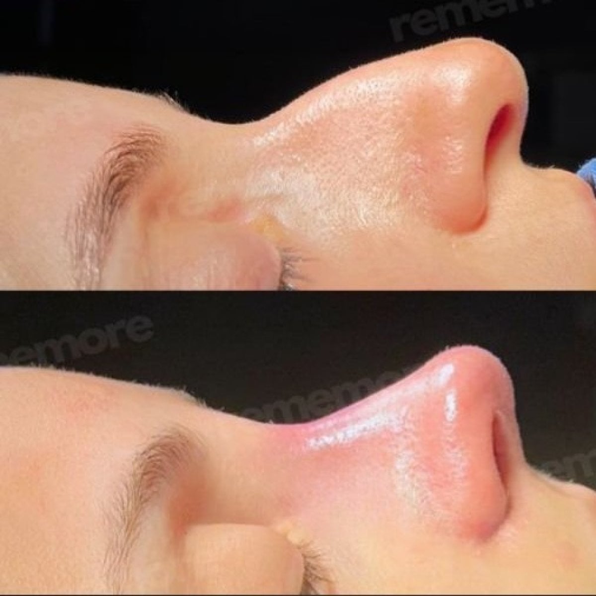 Resultados antes y después de rinoplastia de punta en Memorial Bahçelievler Hospital